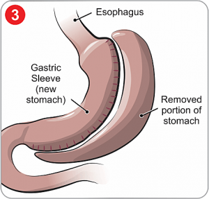 Best Bariatric Weight Loss Surgery Center Jalandhar Punjab